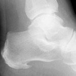 Espolon calcaneo, la causa mas frecuente de dolor en el pie
