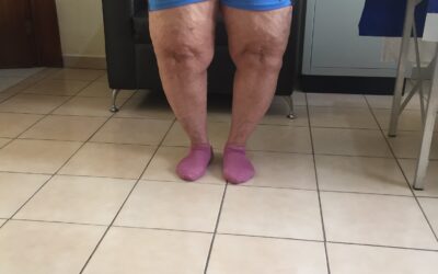 Tratamiento de genu varo en consultorio: mismo momento